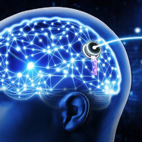 implante cerebral convierte pensamientos en palabras con IA, neurociencia, interfaz cerebro-computadora, privacidad mental, comunicación asistida. Foto: Ilustración.