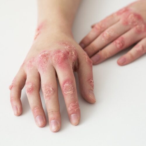 La psoriasis puede afectar la salud si no se trata. Un diagnóstico temprano mejora el pronóstico. Foto: Freepik