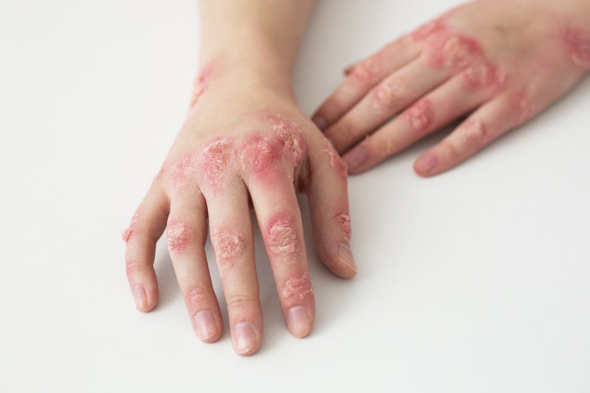 La psoriasis puede afectar la salud si no se trata. Un diagnóstico temprano mejora el pronóstico. Foto: Freepik