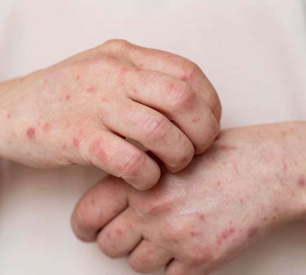 El Salvador enfrenta 11 casos de sarampión importados desde Guatemala y México. Para evitar propagación, se lanza campaña urgente de inmunización en bebés de 6 a 11 meses y se intensifica control en fronteras. (Foto: Freepik) (Freepik)