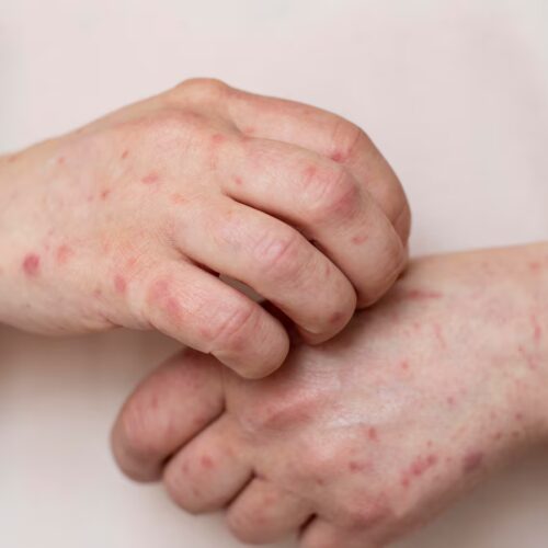 El Salvador enfrenta 11 casos de sarampión importados desde Guatemala y México. Para evitar propagación, se lanza campaña urgente de inmunización en bebés de 6 a 11 meses y se intensifica control en fronteras. (Foto: Freepik) (Freepik)