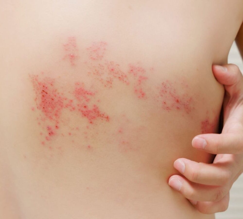 Conoce las diferencias entre el sarampión y la varicela, sus síntomas clave y el protocolo a seguir en El Salvador ante sospechas de contagio. Foto: Ministerio de Salud.