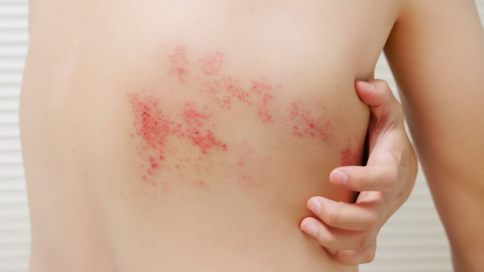 Conoce las diferencias entre el sarampión y la varicela, sus síntomas clave y el protocolo a seguir en El Salvador ante sospechas de contagio. Foto: Ministerio de Salud.